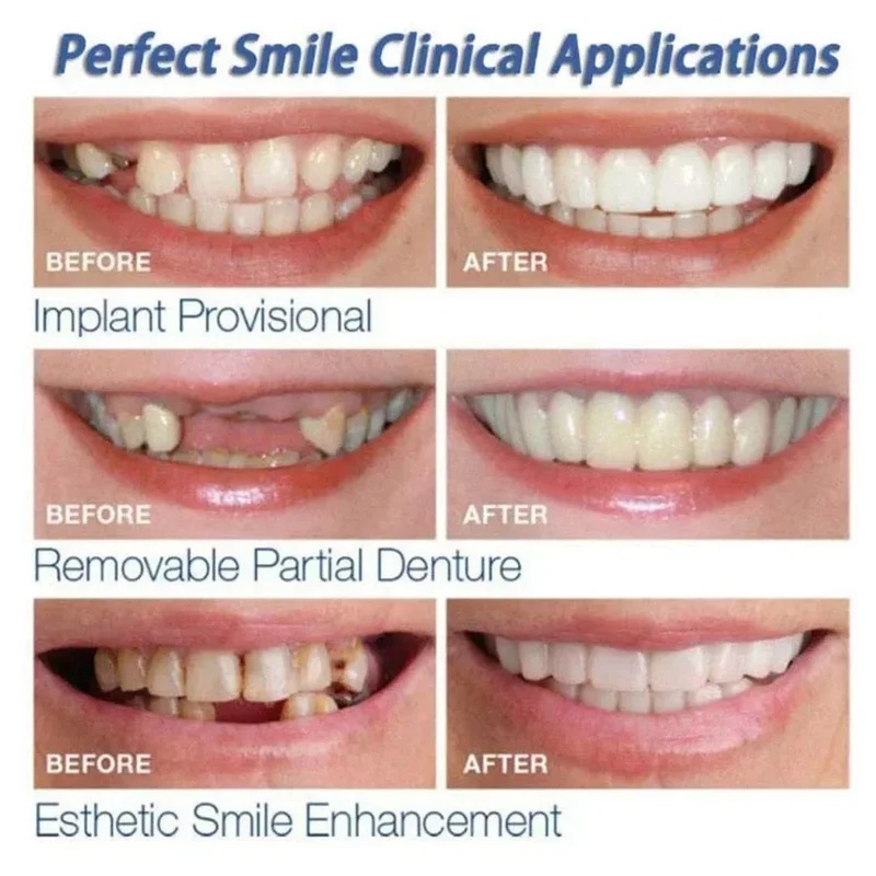 Snap-on Veneer Teeth Kit Adjus - Teeth Whitening Kit ulasan dan harga